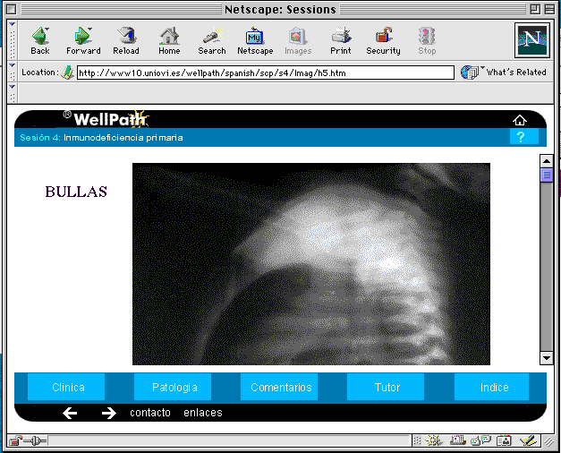 Figura 6: imagen radiológica de una bulla mencionada en la hª clínica